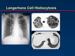 Langerhans Cell Histiocytosis
 