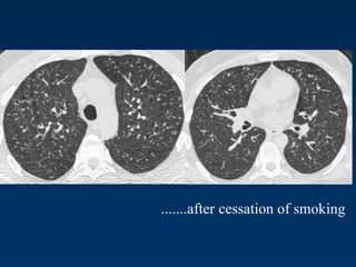 .......after cessation of smoking
 