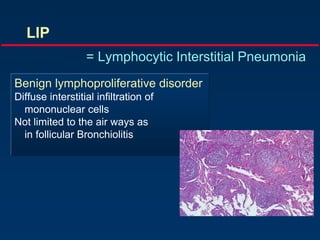 Benign lymphoproliferative disorder
Diffuse interstitial infiltration of
mononuclear cells
Not limited to the air ways as
in follicular Bronchiolitis
LIP
= Lymphocytic Interstitial Pneumonia
 