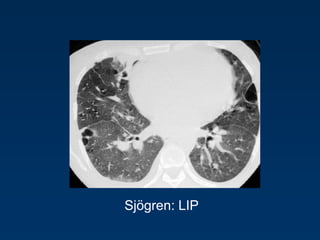 Sjögren: LIP
 