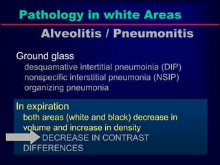 Pathology in white Areas
Alveolitis / Pneumonitis
Ground glass
desquamative intertitial pneumoinia (DIP)
nonspecific interstitial pneumonia (NSIP)
organizing pneumonia
In expiration
both areas (white and black) decrease in
volume and increase in density
DECREASE IN CONTRAST
DIFFERENCES
 