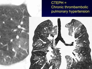 CTEPH =
Chronic thrombembolic
pulmonary hypertension
 