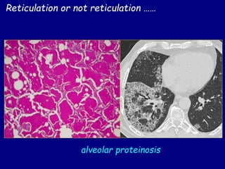 Reticulation or not reticulation ……
alveolar proteinosis
 