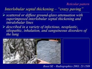 Reticular pattern
Interlobular septal thickening – “crazy paving”
 scattered or diffuse ground-glass attenuation with
superimposed interlobular septal thickening and
intralobular lines
 described in a variety of infectious, neoplastic,
idiopathic, inhalation, and sanguineous disorders of
the lung
Rossi SE – Radiographics 2003; 23:1509
 