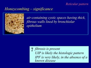 Reticular pattern
Honeycombing – significance
air-containing cystic spaces having thick,
fibrous walls lined by bronchiolar
epithelium

fibrosis is present
UIP is likely the histologic pattern
IPF is very likely, in the absence of a
known disease
 