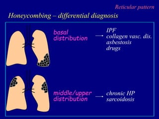 Reticular pattern
Honeycombing – differential diagnosis
basal
distribution
middle/upper
distribution
chronic HP
sarcoidosis
IPF
collagen vasc. dis.
asbestosis
drugs
 