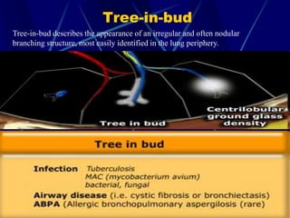 Tree-in-bud
Tree-in-bud describes the appearance of an irregular and often nodular
branching structure, most easily identified in the lung periphery.
 