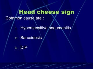 Head cheese sign
Common cause are :
1. Hypersensitive pneumonitis
2. Sarcoidosis
3. DIP
83
 