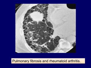Pulmonary fibrosis and rheumatoid arthritis.
 