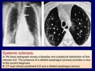 Systemic sclerosis.
A: PA chest radiograph shows a bibasilar and subpleural distribution of fine
reticular ILD. The presence of a dilated esophagus (arrows) provides a clue
to the correct diagnosis.
B: CT scan shows peripheral ILD and a dilated esophagus (arrow).
 