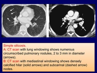 Simple silicosis.
A: CT scan with lung windowing shows numerous
circumscribed pulmonary nodules, 2 to 3 mm in diameter
(arrows).
B: CT scan with mediastinal windowing shows densely
calcified hilar (solid arrows) and subcarinal (dashed arrow)
nodes.
 