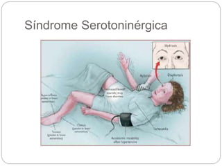 Síndrome Serotoninérgica
 