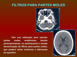 FILTROS PARA PARTES MOLES




       Têm sua utilização para estudar
partes    moles     anatômicas     (tecido
parenquimatoso, ou parênquima) e recebe
denominação de filtros para partes moles,
que poderá variar conforme o fabricante
do aparelho.
 