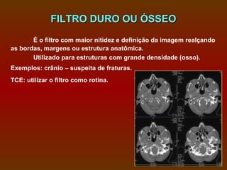 FILTRO DURO OU ÓSSEO
       É o filtro com maior nitidez e definição da imagem realçando
as bordas, margens ou estrutura anatômica.
       Utilizado para estruturas com grande densidade (osso).
Exemplos: crânio – suspeita de fraturas.
TCE: utilizar o filtro como rotina.
 