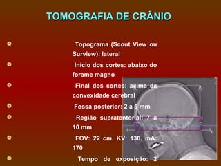 TOMOGRAFIA DE CRÂNIO

       Topograma (Scout View ou
        Surview): lateral
       Início dos cortes: abaixo do
        forame magno
        Final dos cortes: acima da
        convexidade cerebral
       Fossa posterior: 2 a 5 mm
        Região supratentorial: 7 a
        10 mm
        FOV: 22 cm. KV: 130. mA:
        170
        Tempo de exposição: 2
 