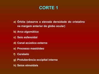 CORTE 1


a) Órbita (observe a elevada densidade do cristalino
  na margem anterior do globo ocular)

b) Arco zigomático

c) Seio esfenoidal

d) Canal acústico externo

e) Processo mastóideo

f) Cerebelo

g) Protuberância occipital interna

h) Seios etmoidais
 