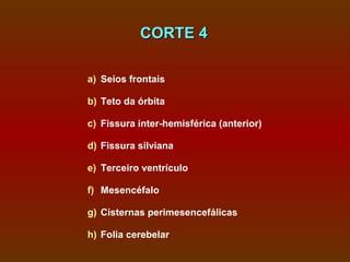 CORTE 4

a) Seios frontais

b) Teto da órbita

c) Fissura inter-hemisférica (anterior)

d) Fissura silviana

e) Terceiro ventrículo

f) Mesencéfalo

g) Cisternas perimesencefálicas

h) Folia cerebelar
 