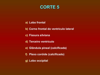CORTE 5


a) Lobo frontal

b) Corno frontal do ventrículo lateral

c) Fissura silviana

d) Terceiro ventrículo

e) Glândula pineal (calcificada)

f) Plexo coróide (calcificado)

g) Lobo occipital
 