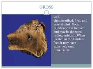 GROSS
well-
circumscribed, firm, and
grayish pink. Focal
calcification is frequent
and may be detected
radiographically.When
located in the hands or
feet, it may have
extremely small
dimensions.
 