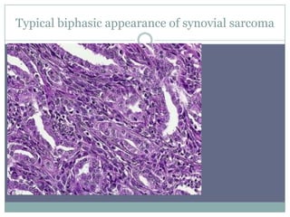 Typical biphasic appearance of synovial sarcoma
 