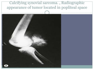 Calcifying synovial sarcoma. , Radiographic
appearance of tumor located in popliteal space
 
