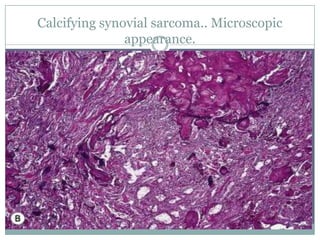 Calcifying synovial sarcoma.. Microscopic
appearance.
 