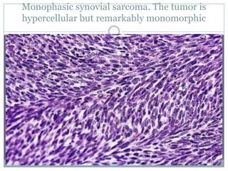 Monophasic synovial sarcoma. The tumor is
hypercellular but remarkably monomorphic
 