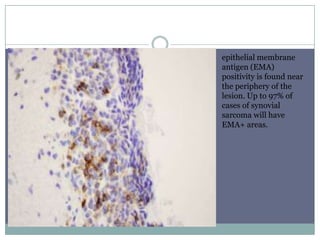 epithelial membrane
antigen (EMA)
positivity is found near
the periphery of the
lesion. Up to 97% of
cases of synovial
sarcoma will have
EMA+ areas.
 