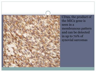 CD99, the product of
the MIC2 gene is
seen in a
membranous pattern
and can be detected
in up to 70% of
synovial sarcomas
 