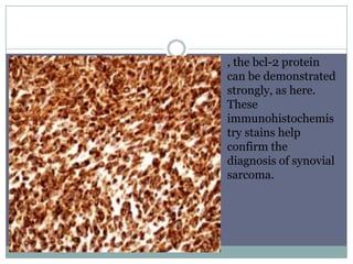 , the bcl-2 protein
can be demonstrated
strongly, as here.
These
immunohistochemis
try stains help
confirm the
diagnosis of synovial
sarcoma.
 