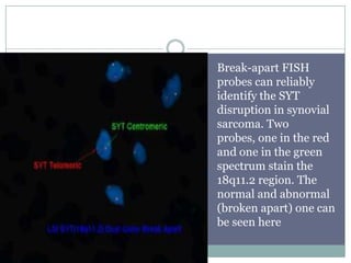 Break-apart FISH
probes can reliably
identify the SYT
disruption in synovial
sarcoma. Two
probes, one in the red
and one in the green
spectrum stain the
18q11.2 region. The
normal and abnormal
(broken apart) one can
be seen here
 