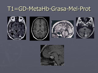 T1=GD-MetaHb-Grasa-Mel-Prot 
