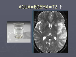 AGUA=EDEMA=T2 
