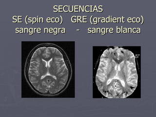SECUENCIAS SE (spin eco)  GRE (gradient eco) sangre negra  -  sangre blanca 