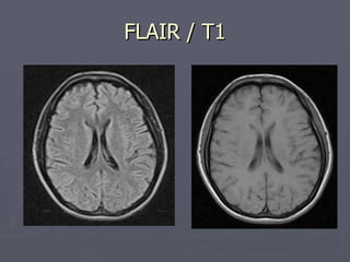 FLAIR / T1 