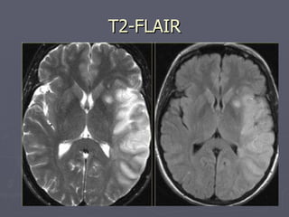 T2-FLAIR 