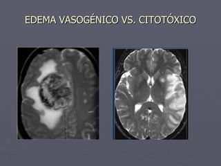 EDEMA VASOGÉNICO VS. CITOTÓXICO 