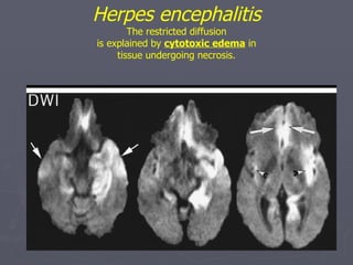 Herpes encephalitis The restricted diffusion is explained by  cytotoxic edema  in tissue undergoing necrosis. 