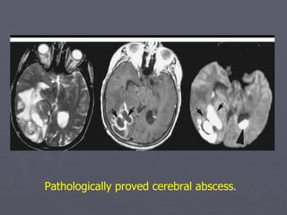 Pathologically proved cerebral abscess . 