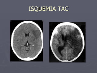 ISQUEMIA TAC 