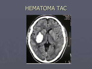 HEMATOMA TAC 