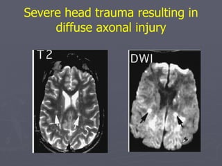Severe head trauma resulting in diffuse axonal injury 