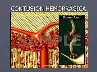 CONTUSION HEMORRÁGICA 