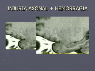 INJURIA AXONAL + HEMORRAGIA 
