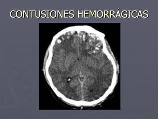 CONTUSIONES HEMORRÁGICAS 