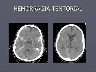HEMORRAGIA TENTORIAL 