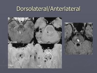 Dorsolateral/Anterlateral 