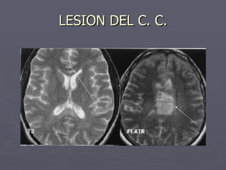 LESION DEL C. C. 