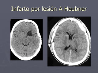 Infarto por lesión A Heubner 