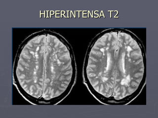 HIPERINTENSA T2 